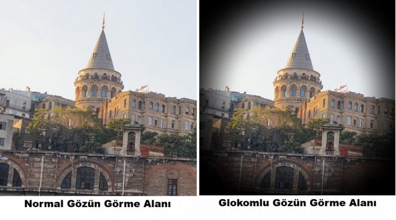 GLOKOM NEDİR